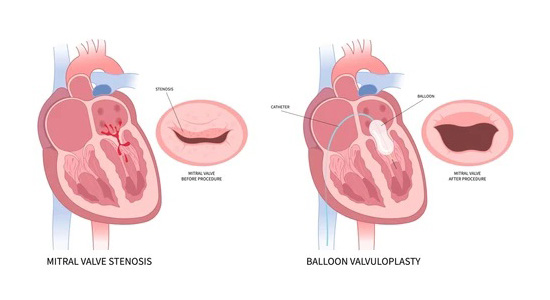 balloon-valvuloplasty